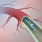 درمان سکته مغزی