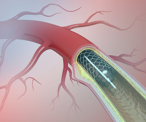 درمان سکته مغزی
