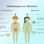 آبله مرغان در بزرگسالان