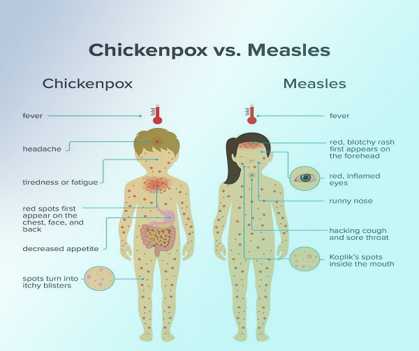 آبله مرغان در بزرگسالان