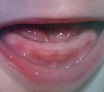 علائم دندان درآوردن نوزاد