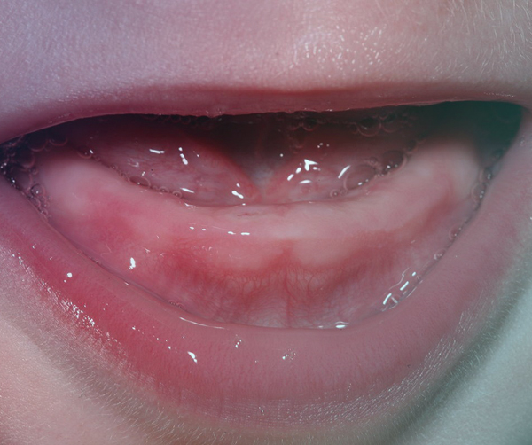 علائم دندان درآوردن نوزاد